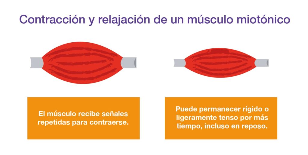 Imagen que muestra la contracción y relajación de músculos miotónicos.